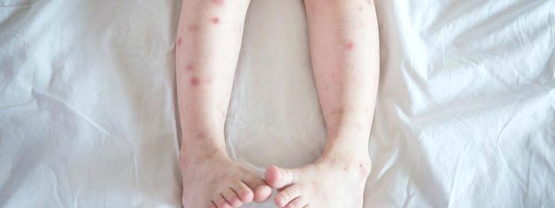 What are health issues caused by bed bugs